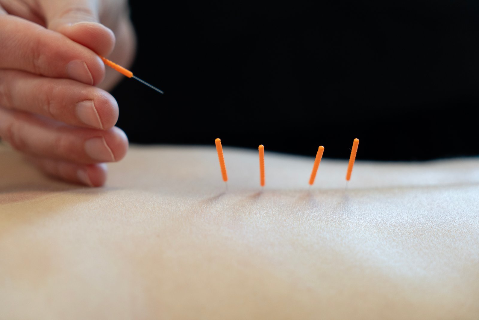 Acupunctură
